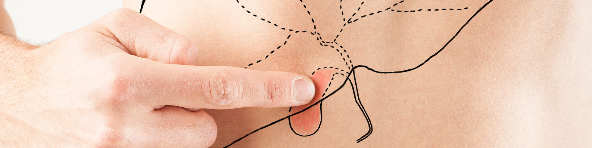 ERCP-stage ERCP-stage