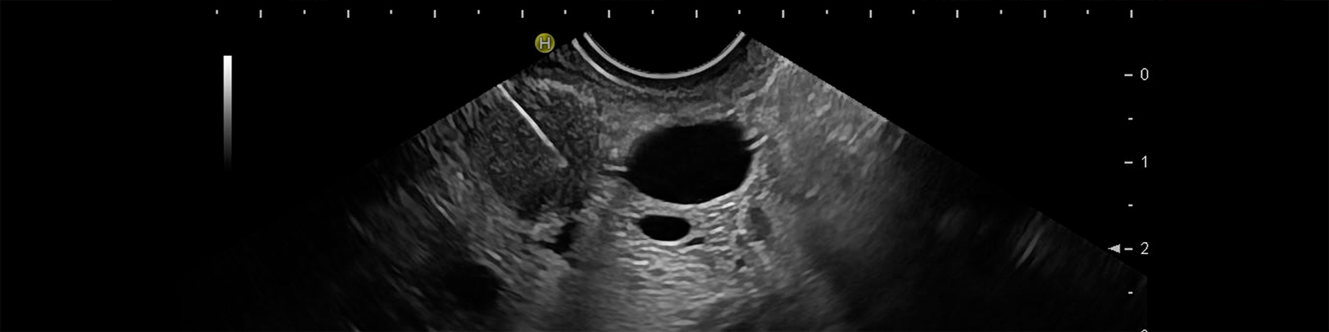 Endoskopischer-Ultraschall-Feinnadelpunktion-header Endoskopischer-Ultraschall-Feinnadelpunktion-header